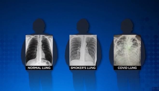 Дәрігер COVID-19-дың адам өкпесіне тигізетін әсері туралы айтты