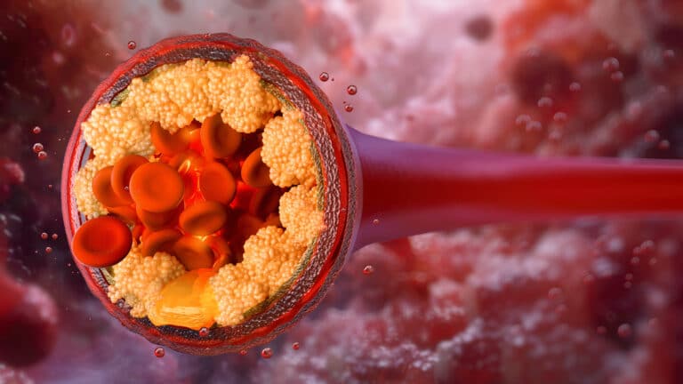 Как формируется атеросклеротическая бляшка