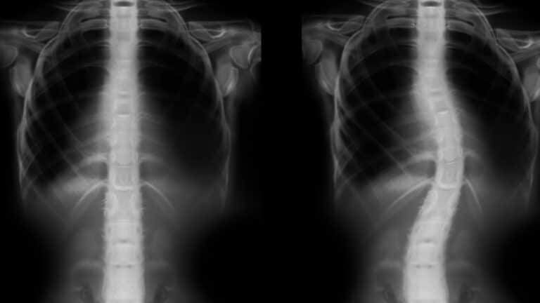 Можно ли вылечить сколиоз у взрослых — или уже поздно?