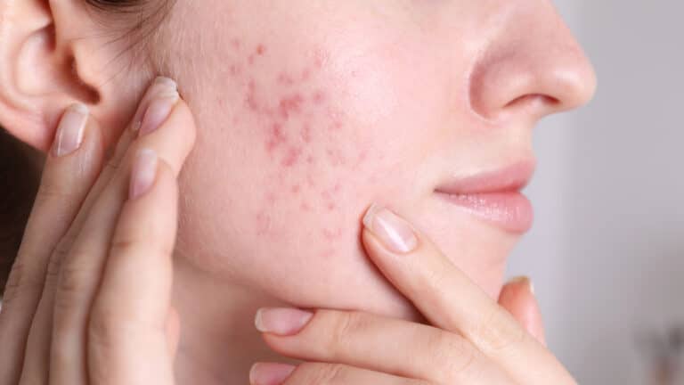Угревая сыпь у взрослых: почему высыпания не проходят