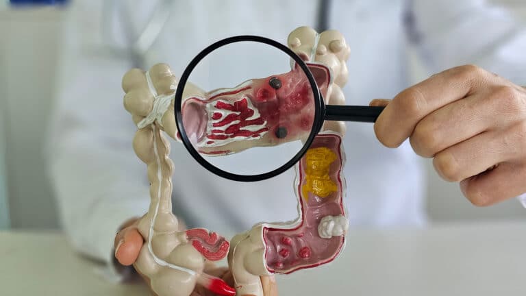 Скрининг рака кишки — когда и как часто проверяться