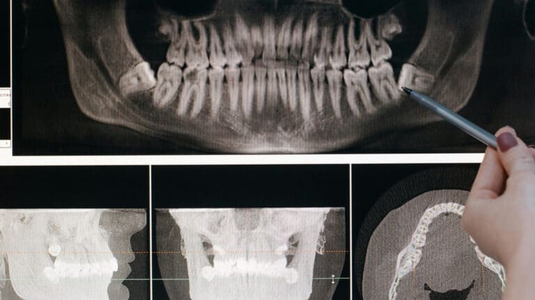 Почему мы скрежещем зубами во сне