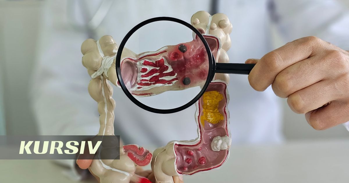 Скрининг рака кишки — когда и как часто проверяться