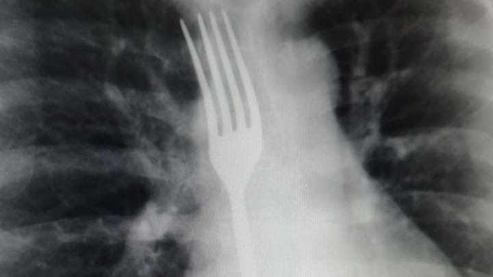 Беларусь әйел лоқсимын деп шанышқы жұтып қойды