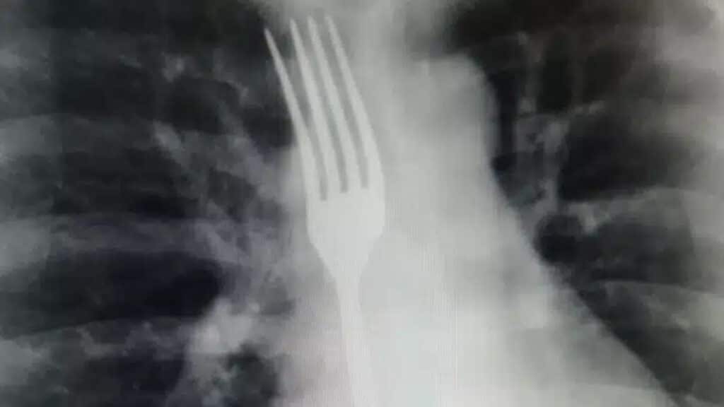 Беларус әйел лоқсимын деп шанышқы жұтып қойды