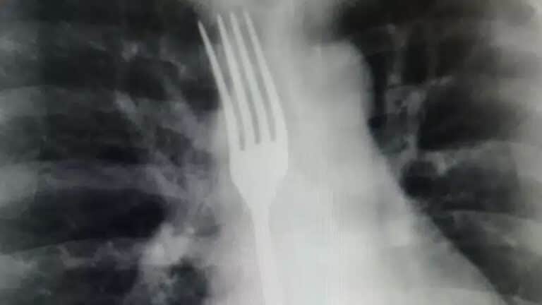 Беларус әйел лоқсимын деп шанышқы жұтып қойды