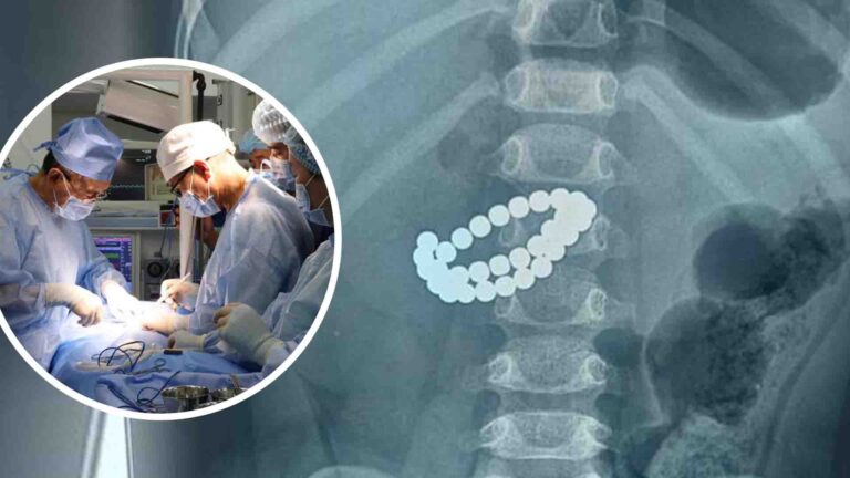 31 магнит жұтып қойған сәбиге шұғыл ота жасалды