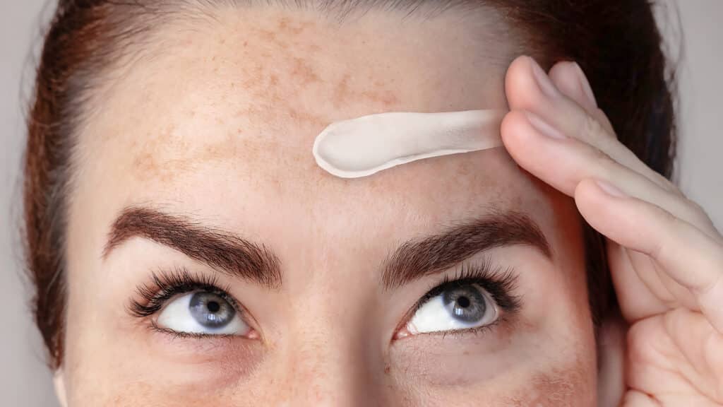 Caucasian woman's face with freckles or age spots,  melasma