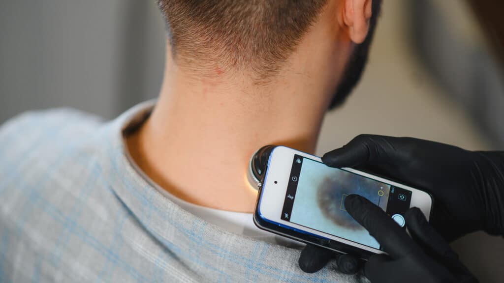 Doctor examining a mole on a patient's neck with a mobile dermatoscope, screening for skin cancer and health