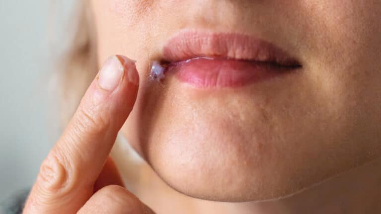 Возможно ли избавиться от герпеса навсегда