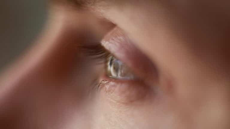 Почему появляются мешки под глазами и как их уменьшить