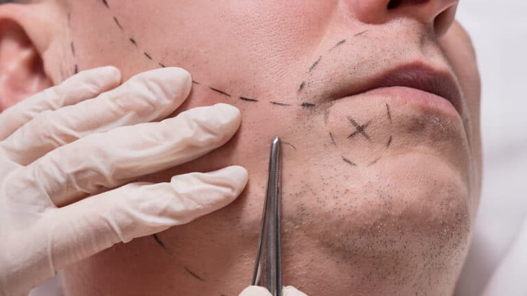 В Испании впервые в мире провели пересадку лица после эвтаназии