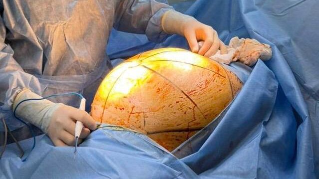 Алматинка скрывала гигантскую опухоль и брала кредиты на БАДы