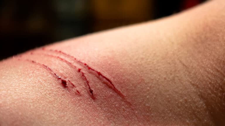 Трое казахстанцев погибли от бешенства в 2025 году