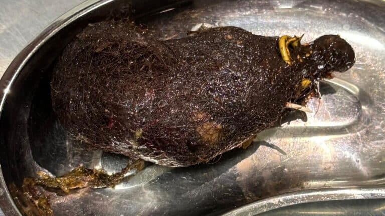 Алматыда шашын жей беретін қыздың асқазанына ота жасалды