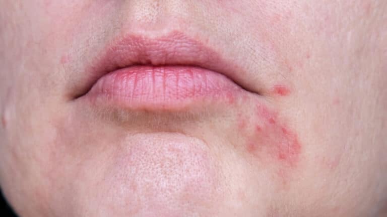Почему появляется сыпь вокруг рта и как с ней связаны кремы и уход