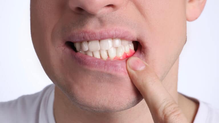 Почему десны стали чувствительными и что с этим делать