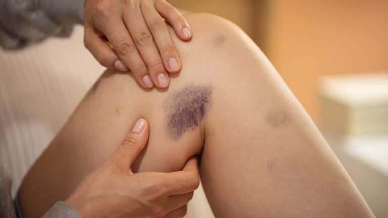 Почему появляются синяки на теле без ударов