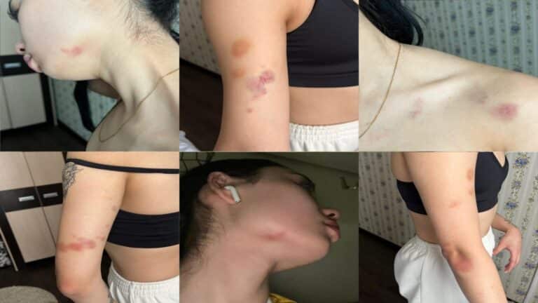 «Травма головы и закрытое дело»: девушка заявила об избиении хоккеистом в Кокшетау