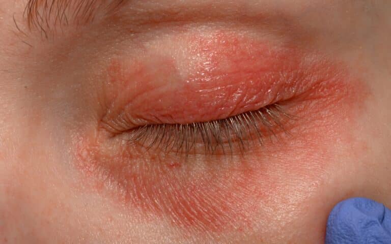 Что известно о состоянии рабочих, которые получили ожоги кислотой на МАЭК в Актау