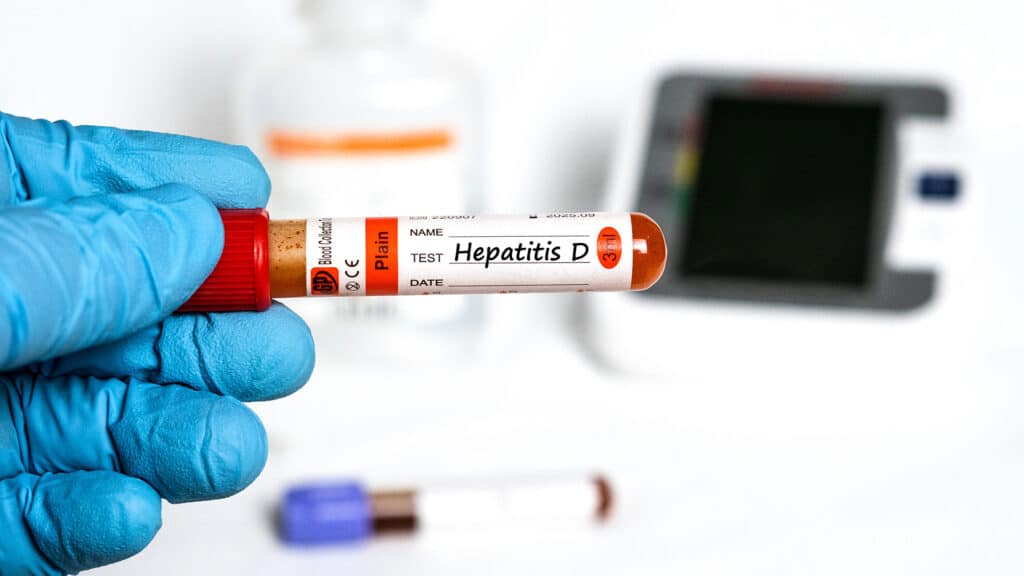 Hepatitis D - Test with a blood sample on a shiny blue hand. Health or medical concept. Bekasi, Indonesia - July 24, 2025.