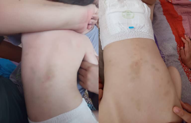 Ақтауда ерекше баланың денесі балабақшадан көкала қойдай көгеріп келген