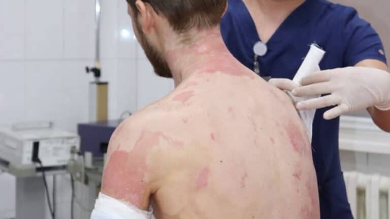 В Алматы врачи спасли парня с ожогами 89% тела после взрыва газового баллона