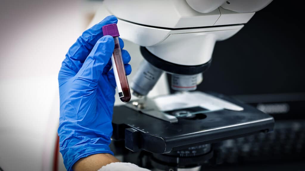 Asian women scientist looking blood test tube and microscope from CBC hematology slide in clinical laboratory.Medical technician analysis blood slide on exam plate microscopic at laboratory department.